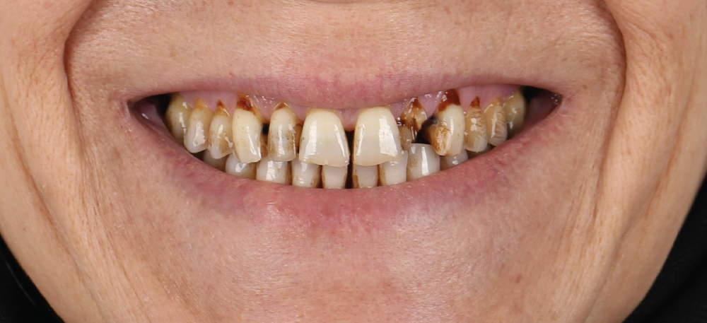 Zirkonyum Kaplama Öncesi ve Sonrası - İnci Diş