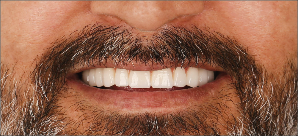 Diş İmplantı & Zirkonyum Kaplama Öncesi ve Sonrası - İnci Diş