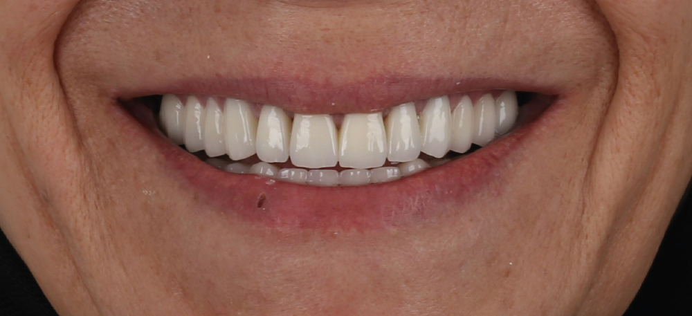 Zirkonyum Kaplama Öncesi ve Sonrası - İnci Diş