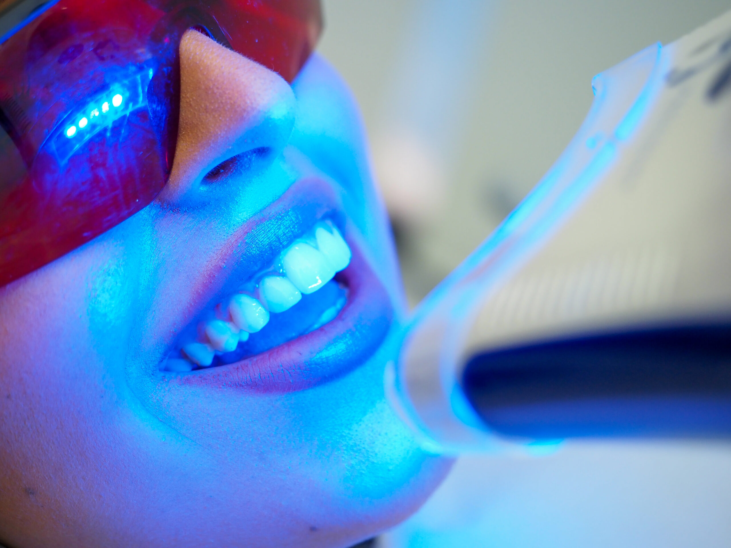 Diş Beyazlatma Yöntemleri ve Diş Beyazlatma Nasıl Yapılır?