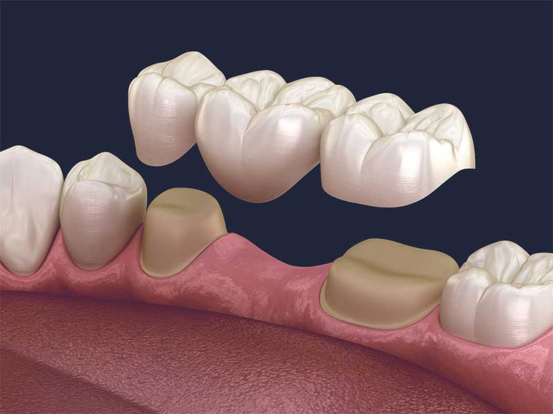 Diş Köprüsü Nedir? Diş Köprüsü Nasıl Yapılır? - İnci Diş Kliniği