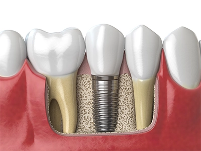 başarısız diş implantı