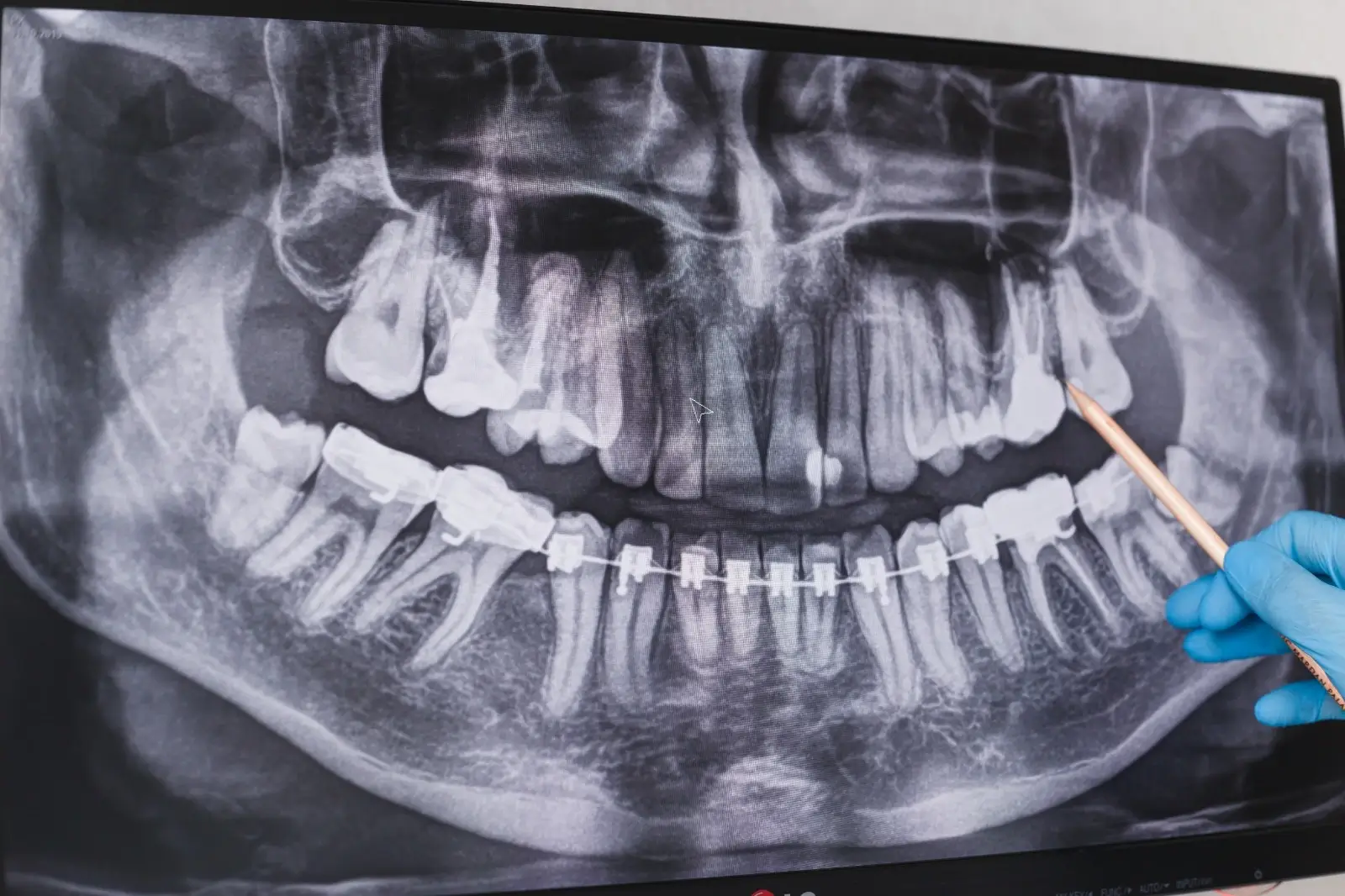 Panoramik diş röntgeni