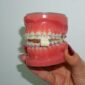 Ortodonti Tedavisinde Sakız Çiğnemek Zararlı mı