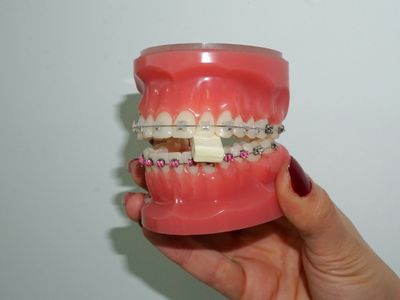 Ortodonti Tedavisinde Sakız Çiğnemek Zararlı mı