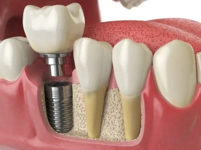 diş çekiminden ne kadar süre sonra implant